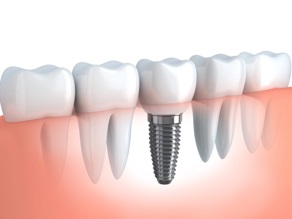 dental implant surgery