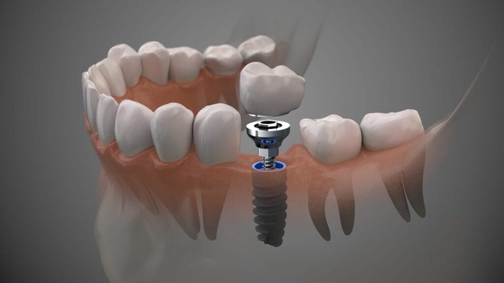 guided dental implant placement