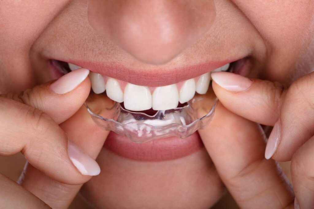 Clear Braces: Aligners & Teeth Straightening Encinitas, CA