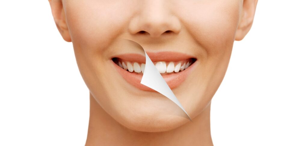 Professional teeth whitening