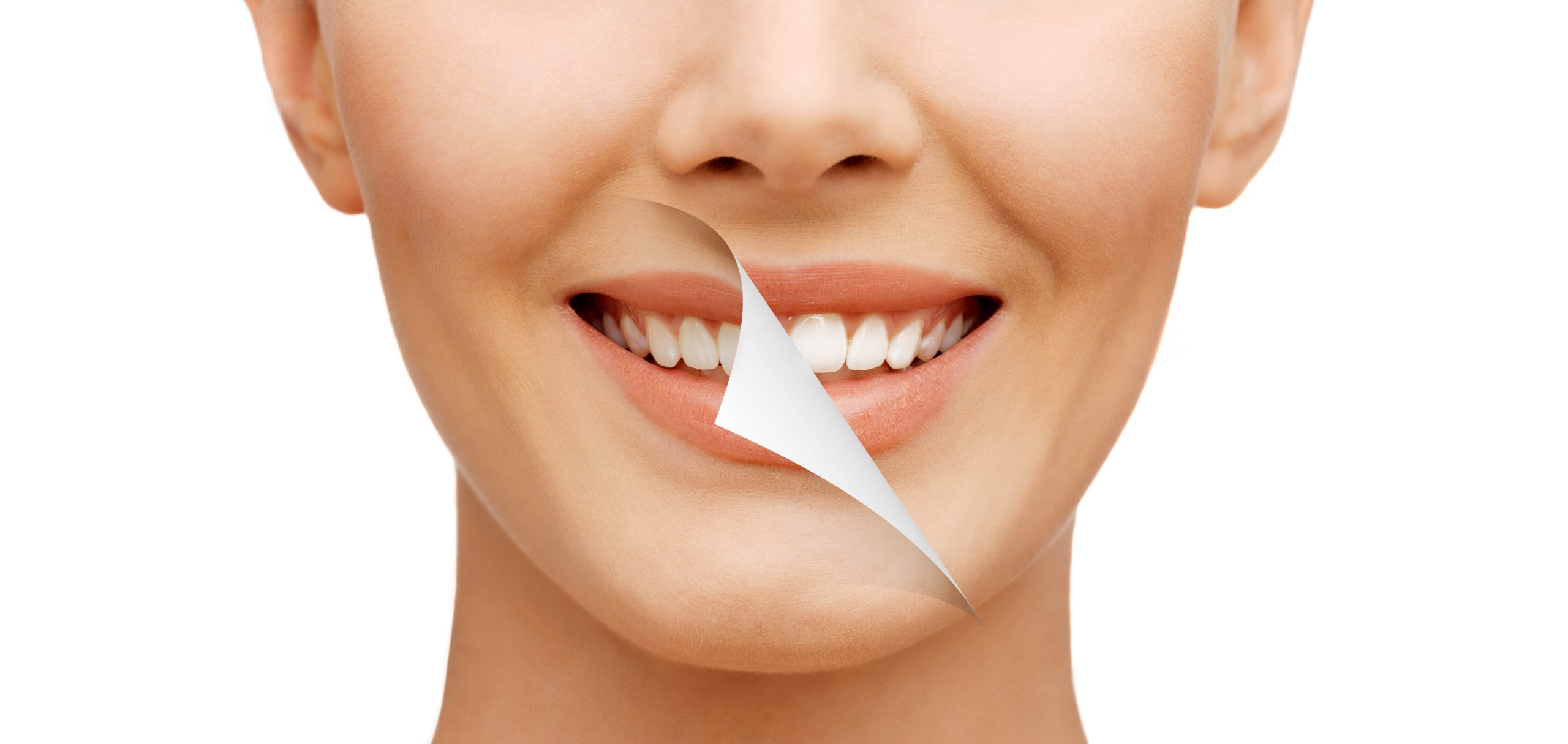 Professional teeth whitening
