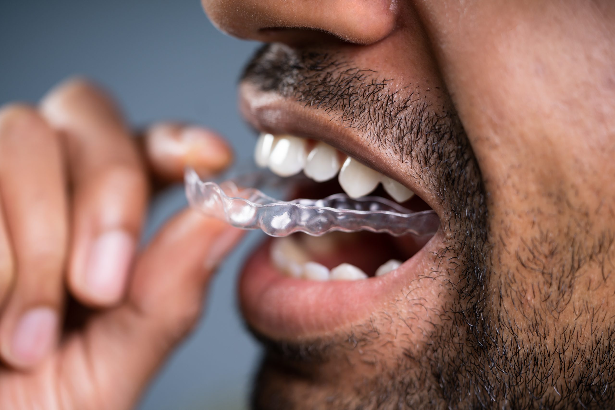 clear braces in Encinitas
