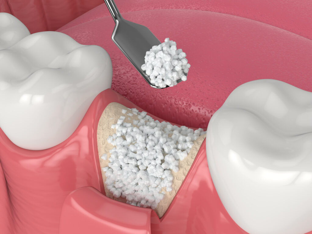 Benefits and Advantages of Bone Grafting for Dental Implants in Encinitas