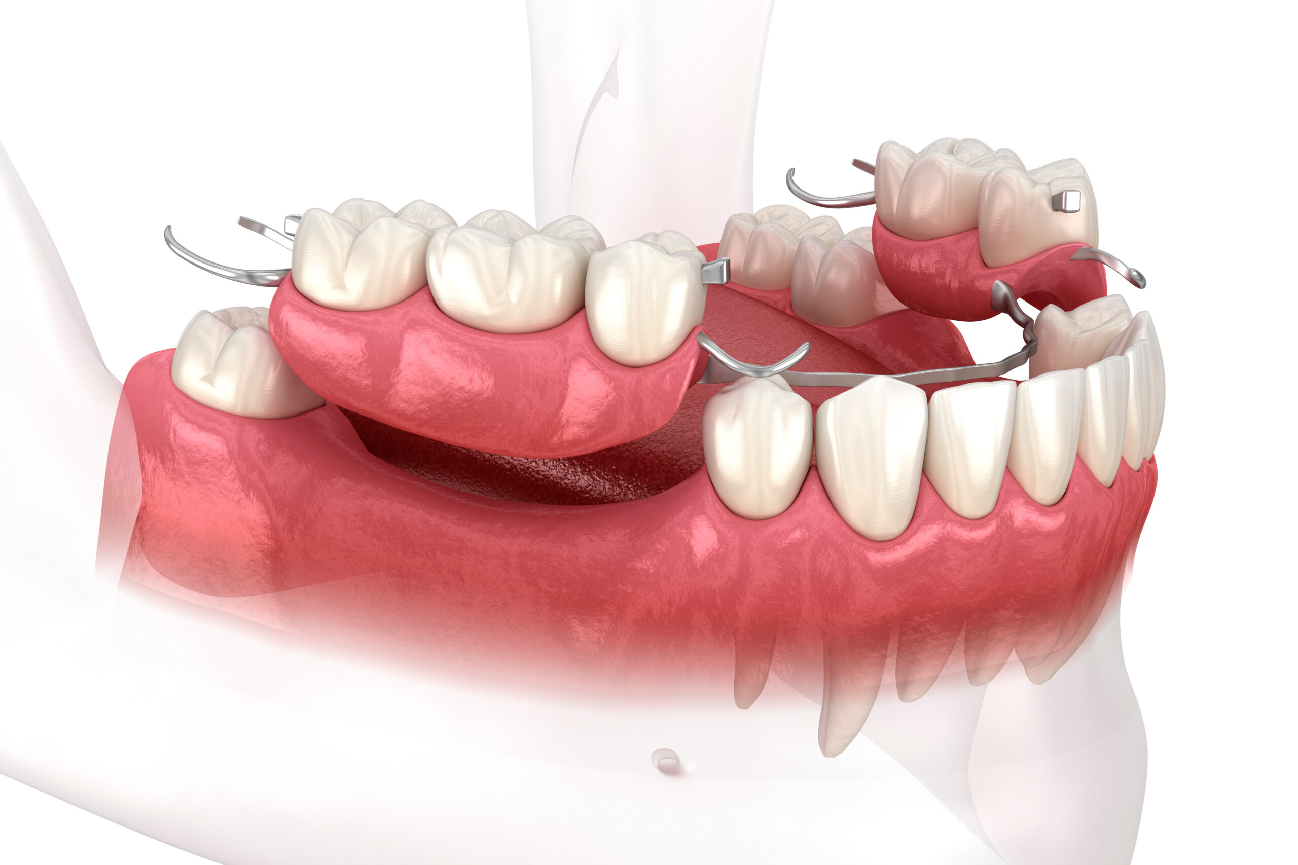 partial dentures in Encinitas, CA.