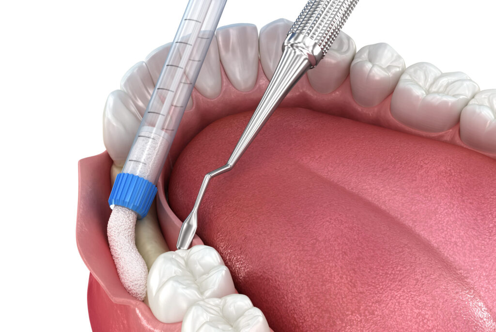 Understanding Bone Grafting: What Is It and When Is It Necessary?