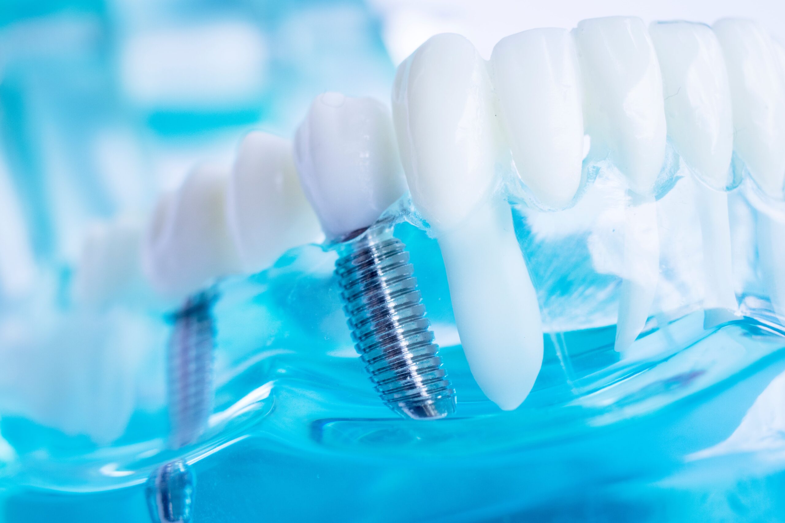 Dental Implants: Enhancing Smiles and Restoring Confidence