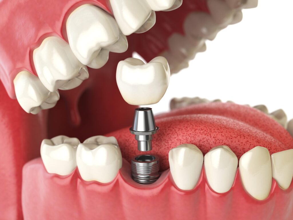 What Happens if You Don't Get an Implant Tooth?