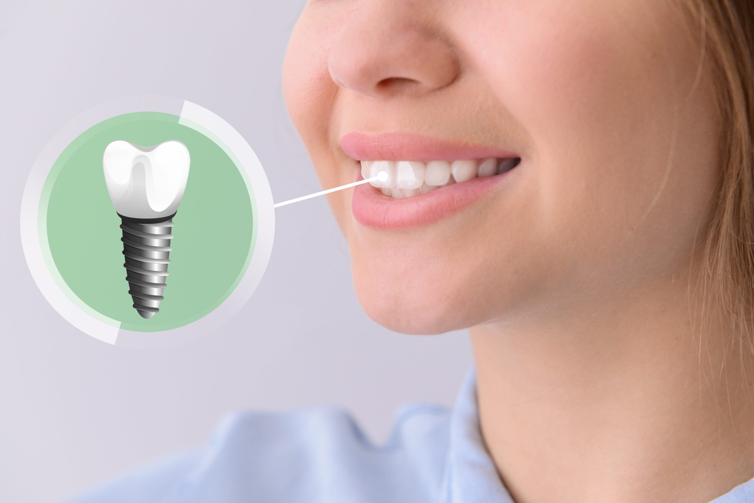 Consequences of Skipping a Tooth Implant: Why You Shouldn't Delay the Procedure