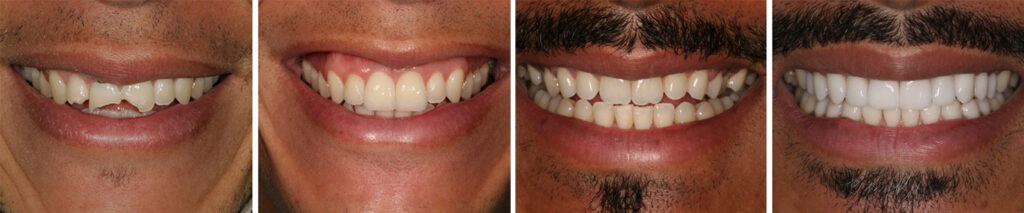 Before and After Images of Dental Restoration and Dental Alignments