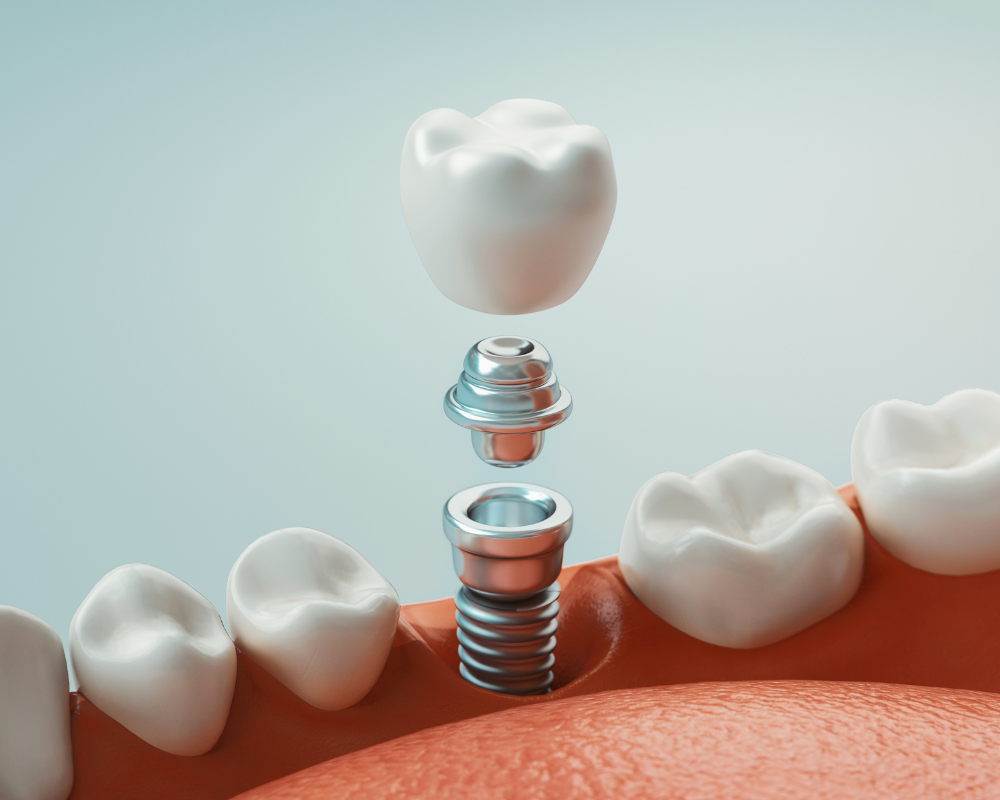 Dental Implants in Encinitas