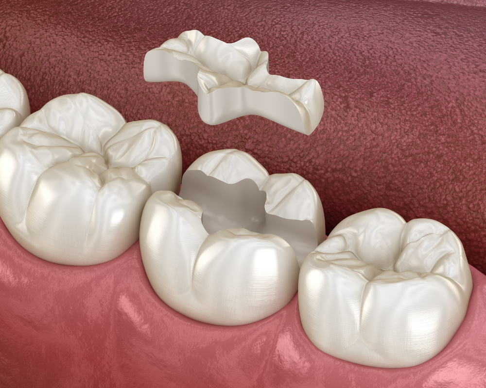 Inlays and Onlays at Greg Skeens, DDS