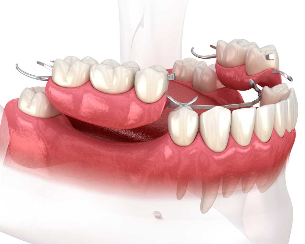 Partial Dentures at Greg Skeens, DDS