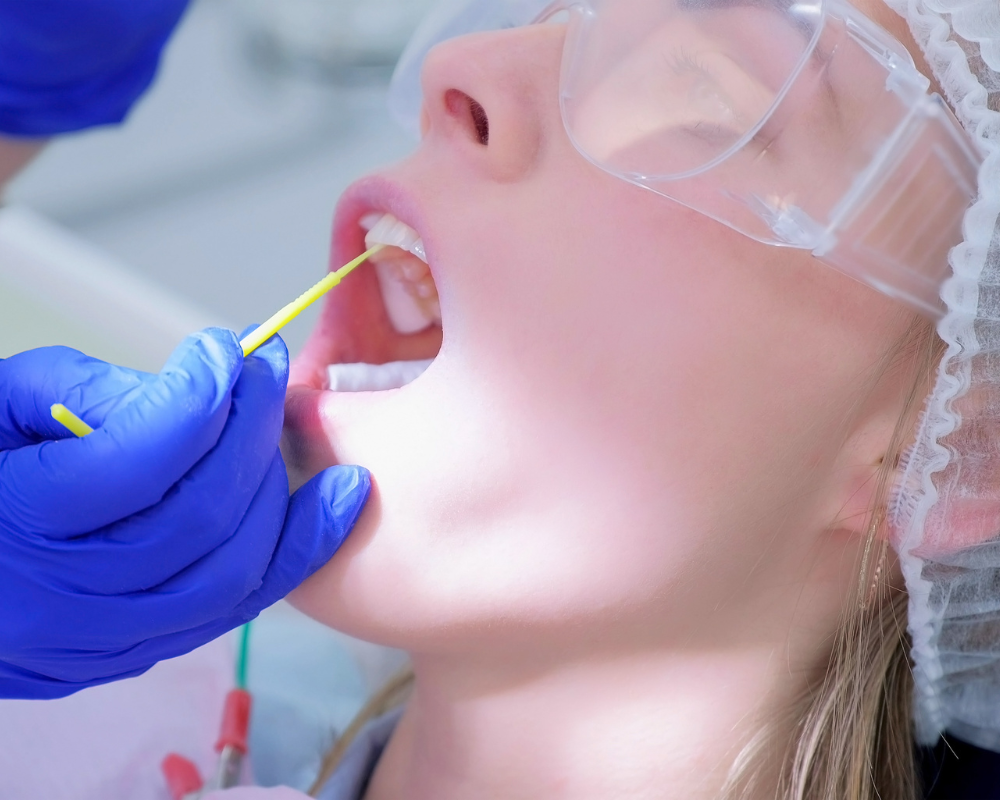 Sealants and Fluoride