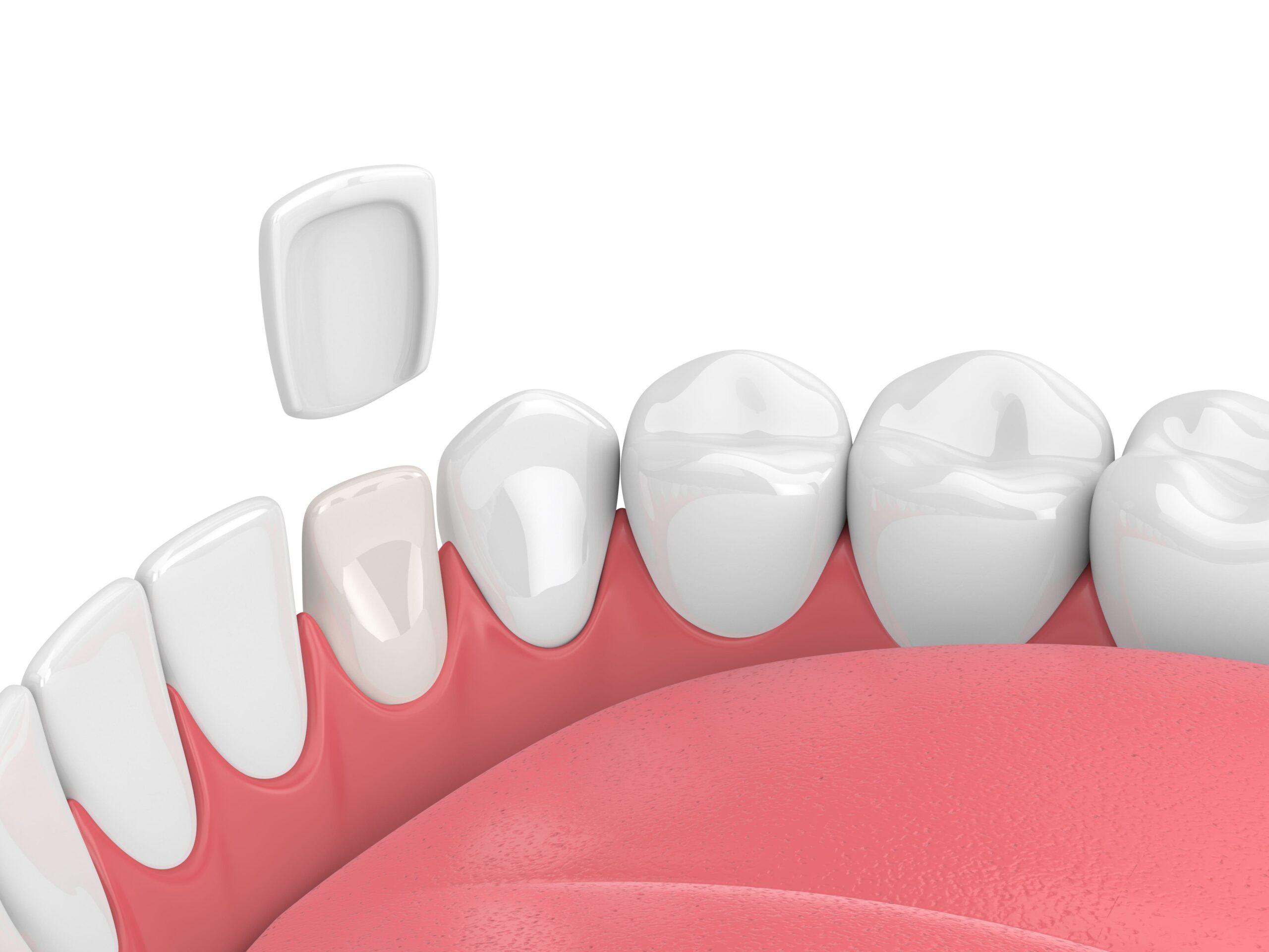 Things to Consider Before Getting Dental Veneers