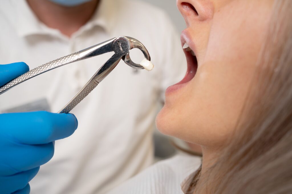 What to Expect After a Tooth Extraction