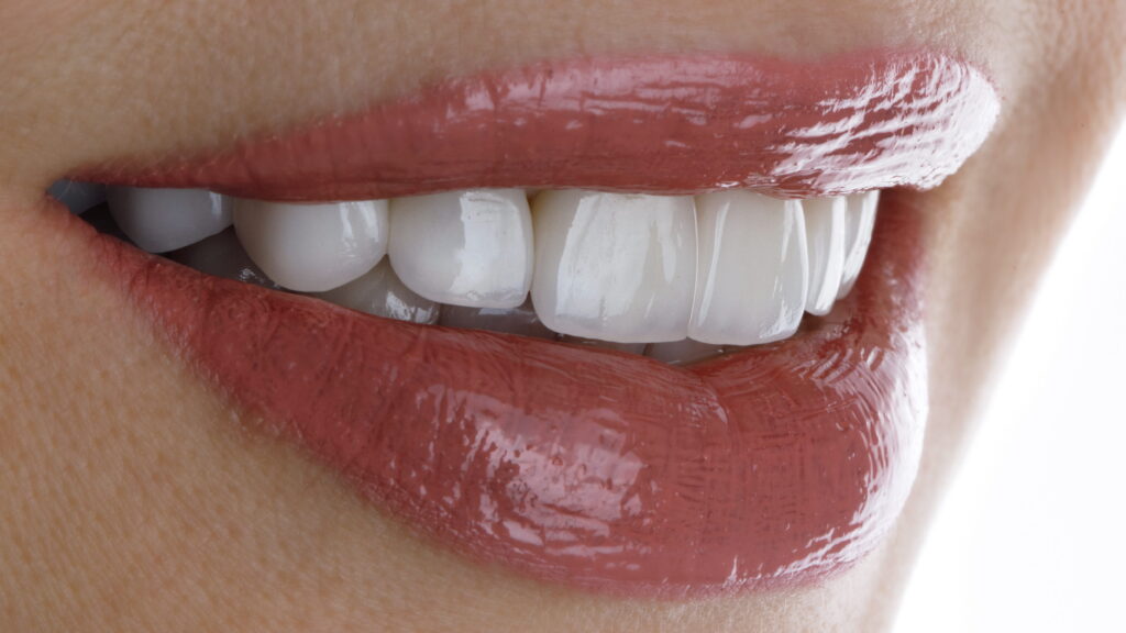 Porcelain Veneers: The Detailed Process for a Beautiful Transformation