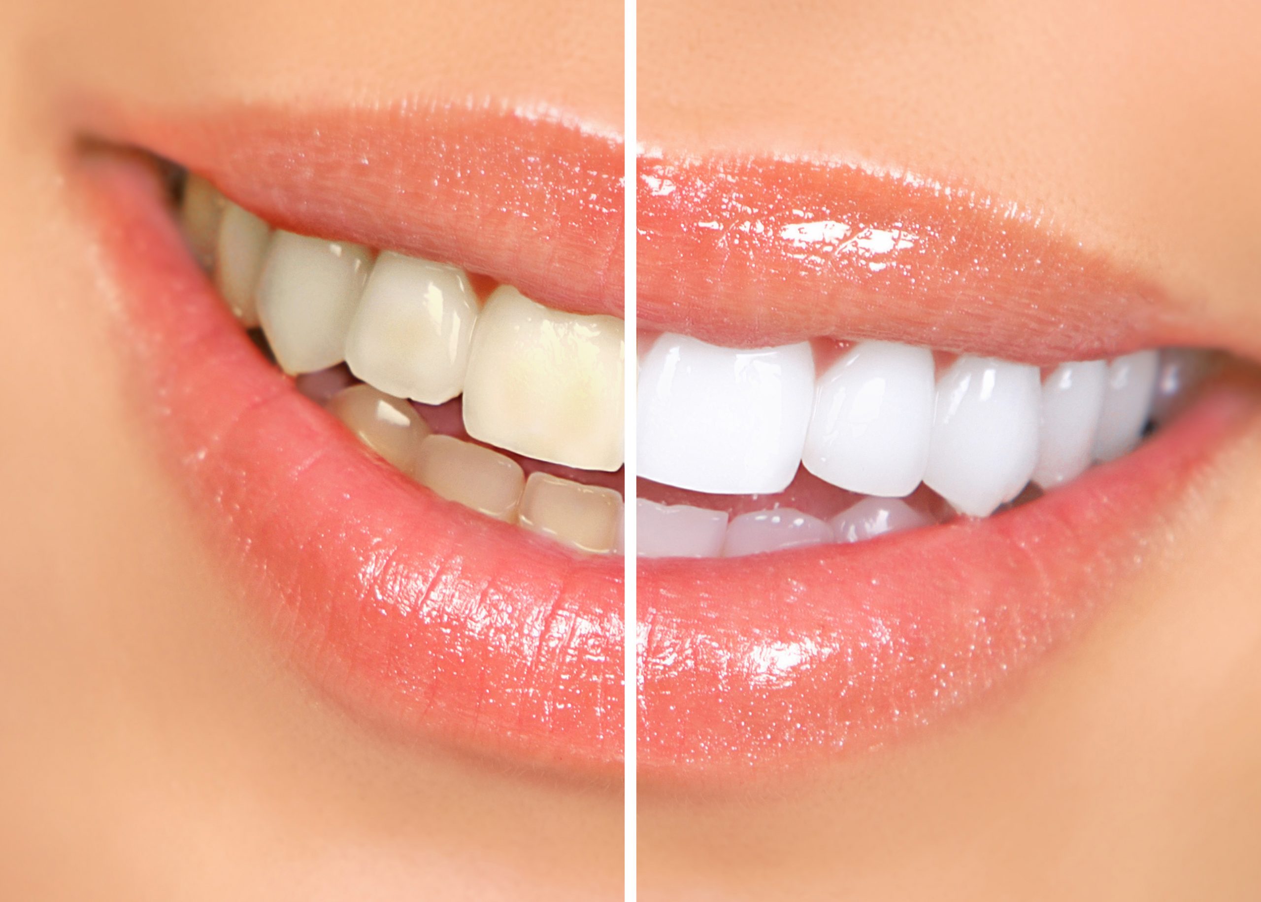 Teeth Whitening Encinitas