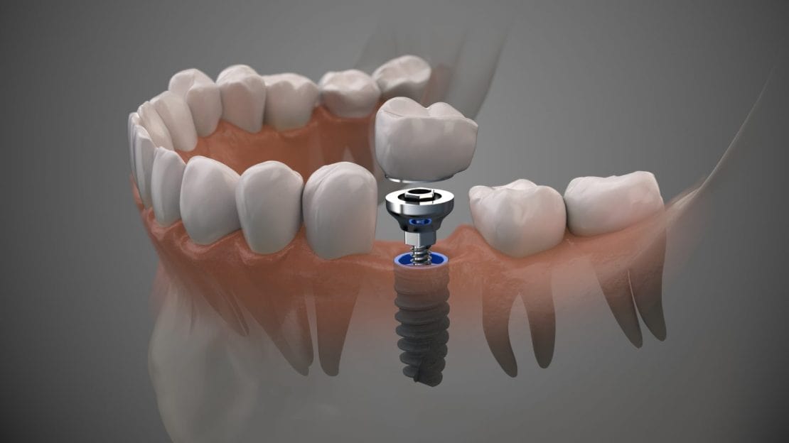 All About Guided Dental Implant PlacementGregory skeens d.d.s.encinitas family dentistry