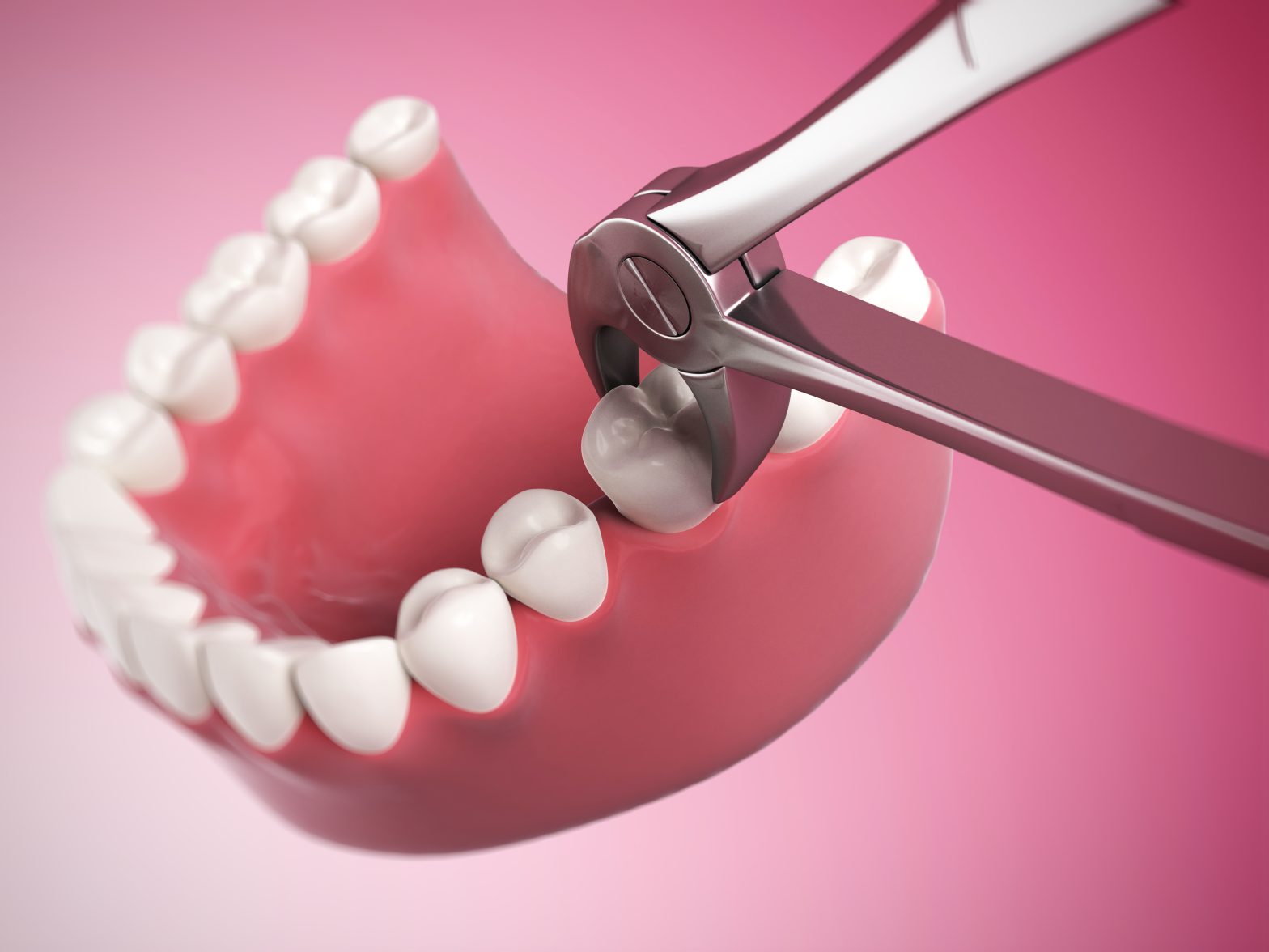 When to See a Dentist After a Tooth ExtractionGregory skeens d.d.s.encinitas family dentistry