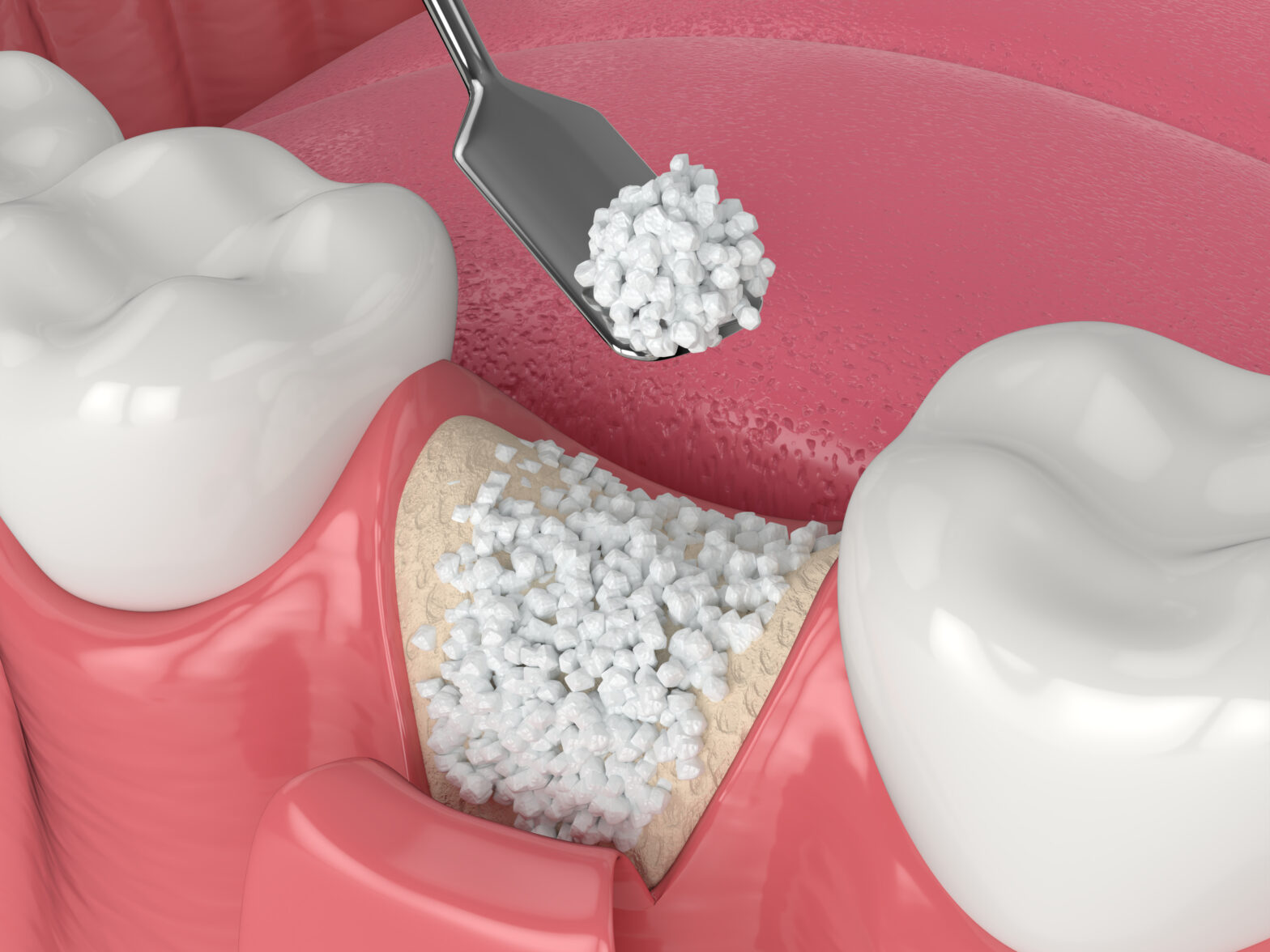 Benefits and Advantages of Bone Grafting for Dental Implants in EncinitasGregory skeens d.d.s.encinitas family dentistry