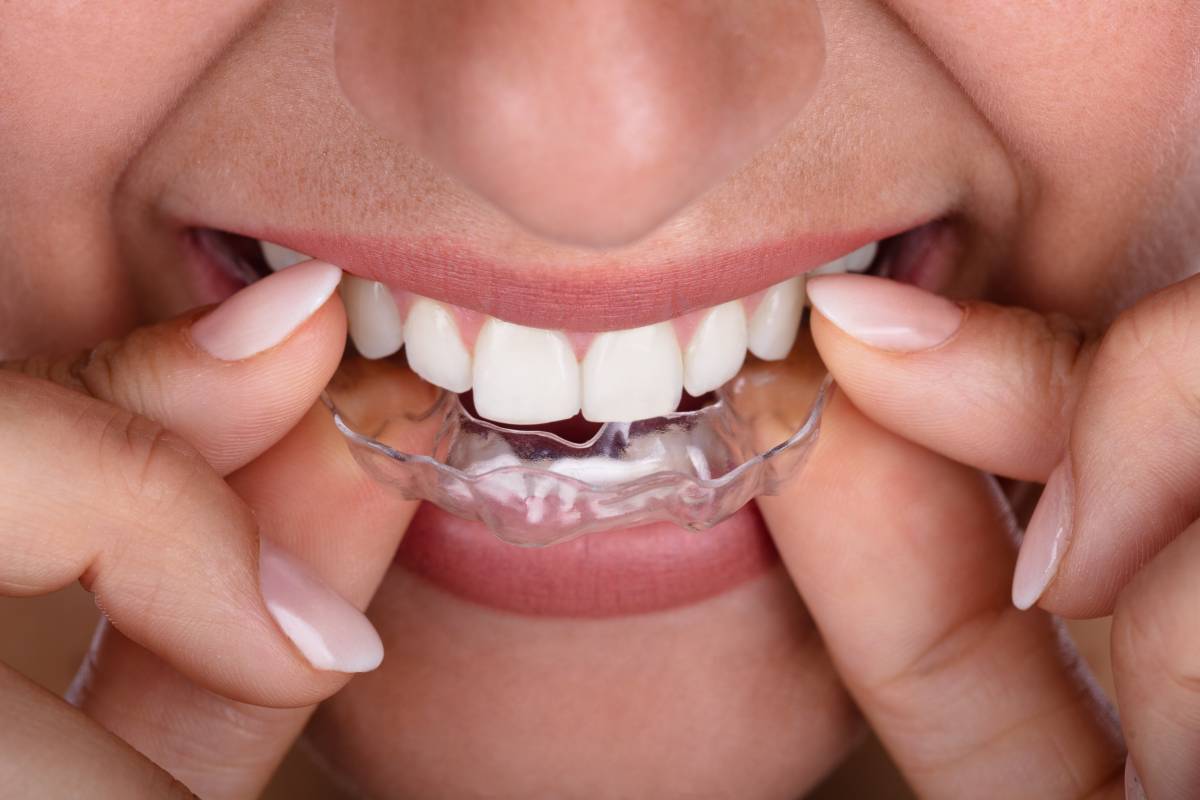 Clear Braces: Aligners & Teeth StraighteningGregory skeens d.d.s.encinitas family dentistry
