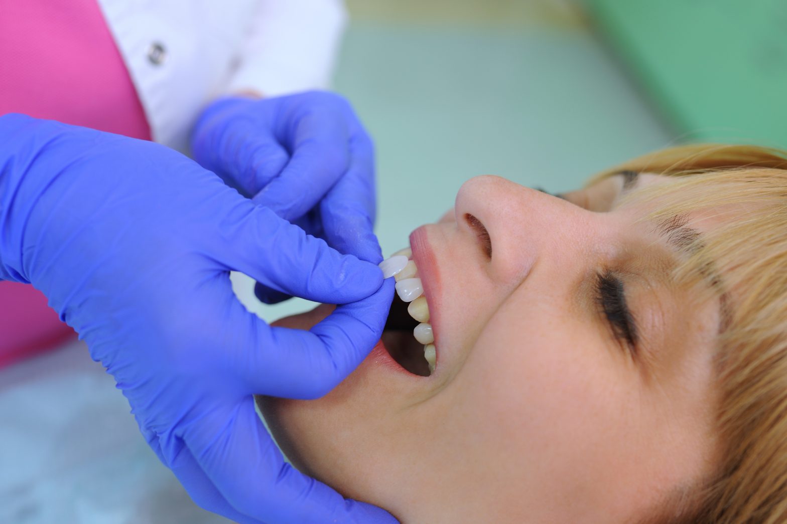 The Benefits of Dental VeneersGregory skeens d.d.s.encinitas family dentistry
