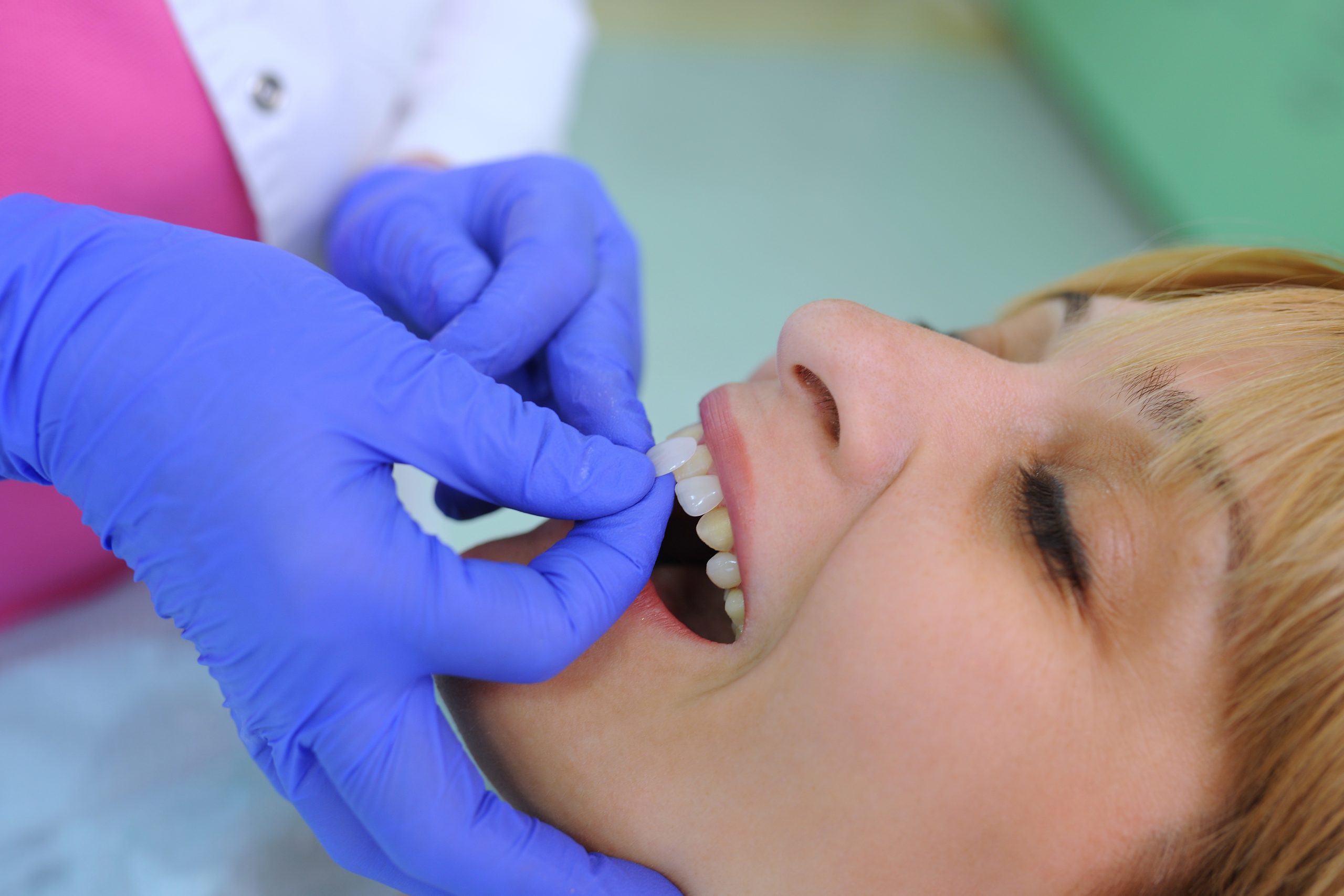 The Benefits of Dental Veneers
