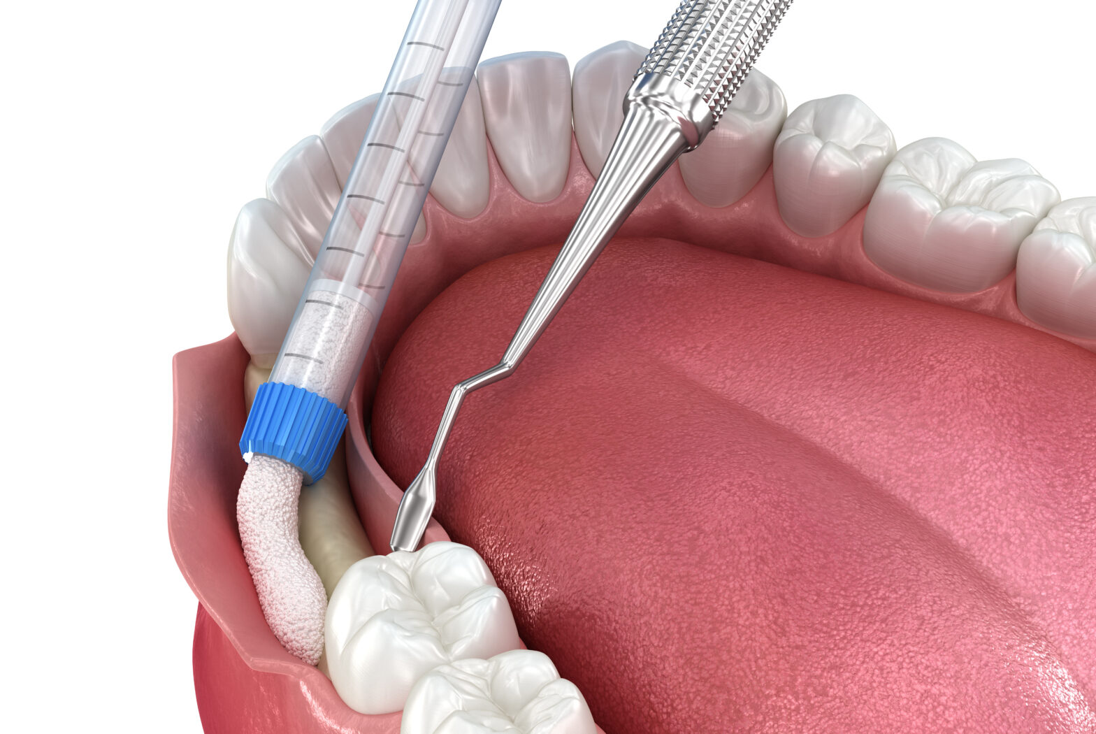 Understanding Bone Grafting: What Is It and When Is It Necessary?Gregory skeens d.d.s.encinitas family dentistry