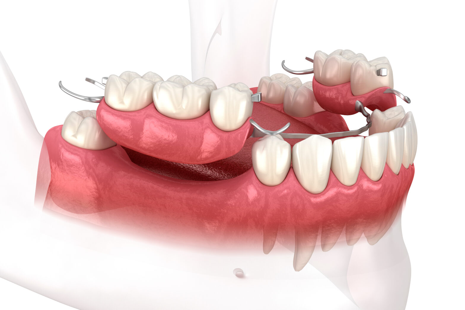 What Are Partial Dentures and How Are They Used?Gregory skeens d.d.s.encinitas family dentistry