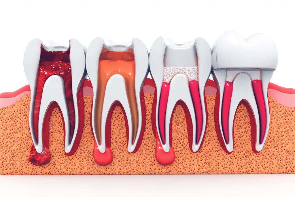 Root Canal 101Gregory skeens d.d.s.encinitas family dentistry